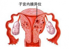 子宫内膜异位症是一种什么样的疾病