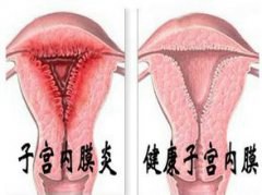患有子宫内膜炎，如何从“吃”上进行调理