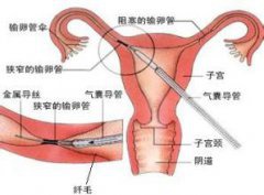 输卵管堵塞的症状有哪些  中医中药如何治疗