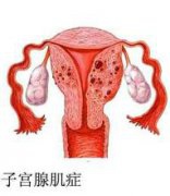 子宫腺肌症有哪些治疗方法？