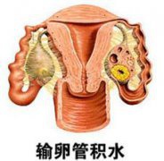 输卵管积水能怀孕吗？