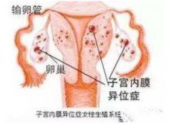 妇炎丸要怎么治疗子宫内膜异位症好呢？