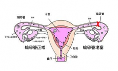 输卵管堵塞不要愁 专利药妇炎丸解忧愁