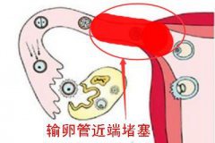 输卵管堵塞了，为啥吃妇炎丸就管用