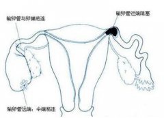 输卵管堵塞的这几大原因，你一定要知道！