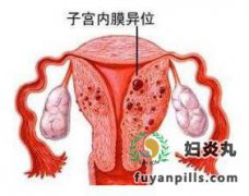经血逆流致内异症发生?内异症怎么办?