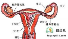 输卵管粘连别慌张 做好这些可预防