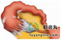 输卵管粘连也分单\双侧?输卵粘连的知识知多少