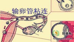 输卵管粘连的原因你知道哪些?一起来看看吧
