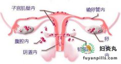 这些原因可能导致子宫内膜异位生长