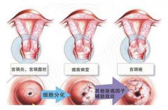 宫颈炎需要做哪些临床检查?