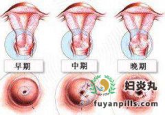 不同程度的宫颈糜烂症状都一样吗?