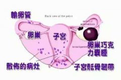 内异症离我们有多远，究竟什么原因发生内异症