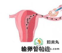 得了输卵管粘连还可以怀孕吗?