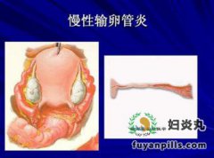 得了输卵管炎用什么方法治疗比较好?