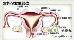 这几类女性当心患上宫外孕