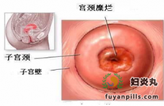 人流会引起宫颈糜烂吗?