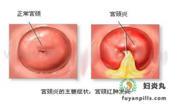 宫颈肥大要不要治疗？