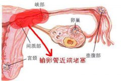 输卵管堵塞到底是怎么引起的？