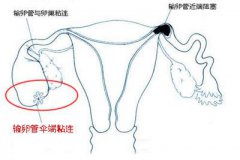 有这些症状请警惕输卵管粘连