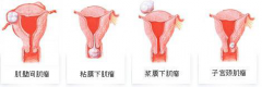 中年女性要小心患上子宫肌瘤