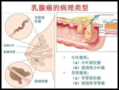女性乳腺癌是如何发病的？