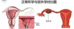 怎样可以积极预防女性异位妊娠？