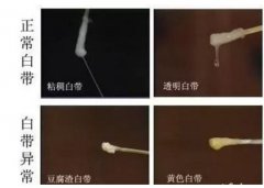 效果最好的妇科消炎药
