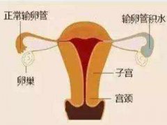 输卵管堵塞吃中药有用吗？近端怎么治疗？