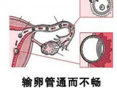 中药是否可以治疗输卵管堵塞上举积水