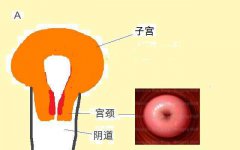 宫颈糜烂是什么？为何要曲解它？