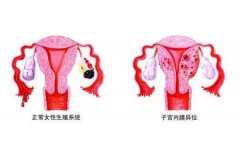 子宫内膜异位手术治疗效果怎么样