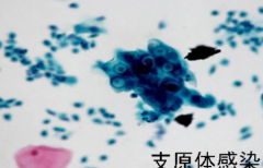 支原体感染吃什么药最有效