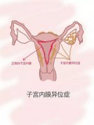 子宫内膜异位症的危害
