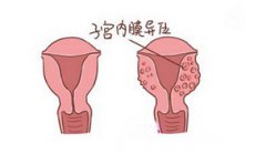 导致子宫内膜异位症发生的具体病因有哪些?