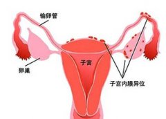 经期运动为什么会导致子宫内膜异位症