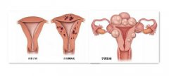 子宫腺肌症与子宫肌瘤之间有哪些区别
