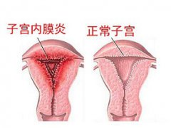 子宫腺肌症病情发展分三个阶段,你属于哪个?