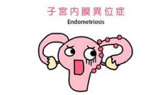 盆腔子宫内膜异位症三期是什么意思