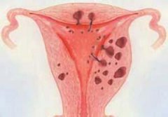 子宫腺肌症子宫增大怎么办?