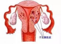 子宫腺肌症能彻底治愈吗