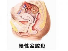 盆腔炎的危害