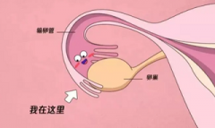 仅有一条输卵管该如何备孕