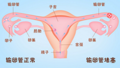 输卵管堵塞为什么会引起疼痛症状