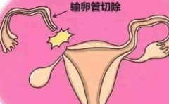 切除输卵管对女性健康有影响吗