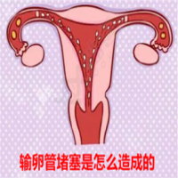 输卵管堵塞是怎么造成的